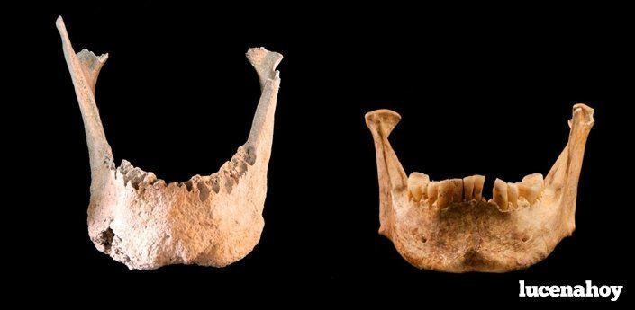  Comparativa entre ls mandíbulas del "gigante" de la necrópolis judía de Lucena y otro individuo normal de la misma. 